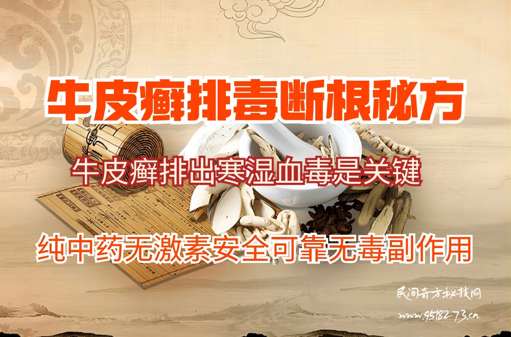祖传秘方牛皮癣排毒断根疗法